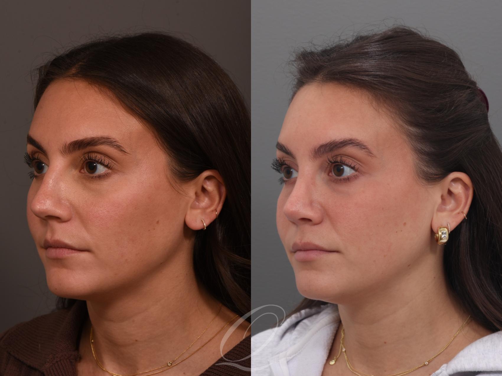 Rhinoplasty Case 1001970 Before & After Left Oblique | Serving Rochester, Syracuse & Buffalo, NY | Quatela Center for Plastic Surgery