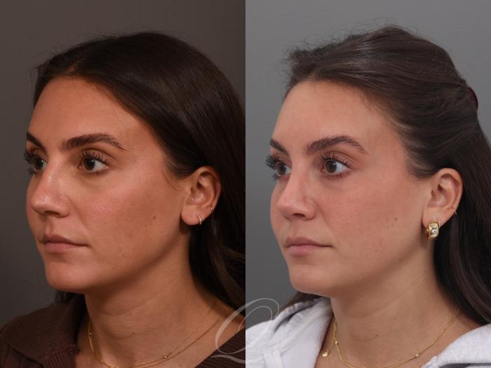 Rhinoplasty Case 1001970 Before & After Left Oblique | Serving Rochester, Syracuse & Buffalo, NY | Quatela Center for Plastic Surgery