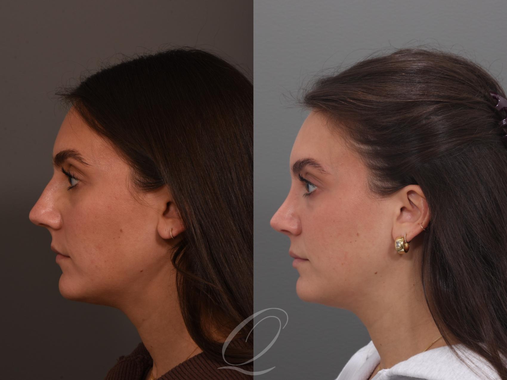 Rhinoplasty Case 1001970 Before & After Left Side | Serving Rochester, Syracuse & Buffalo, NY | Quatela Center for Plastic Surgery