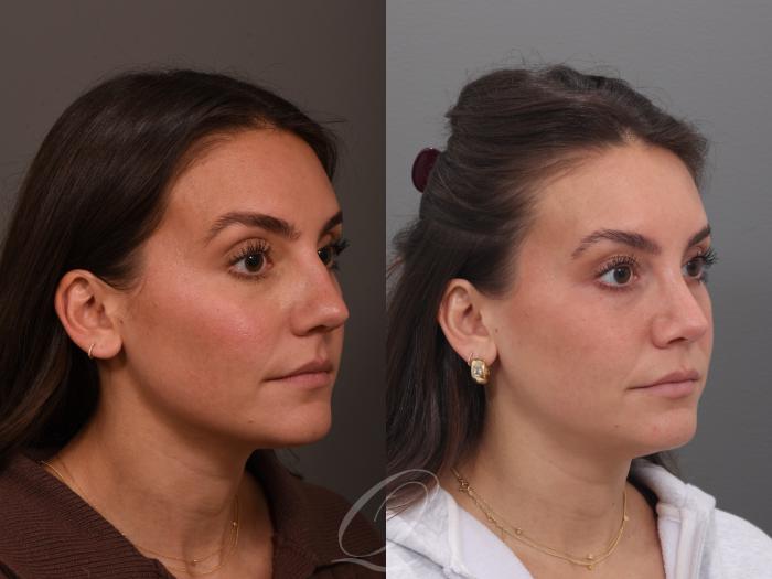 Rhinoplasty Case 1001970 Before & After Right Oblique | Serving Rochester, Syracuse & Buffalo, NY | Quatela Center for Plastic Surgery