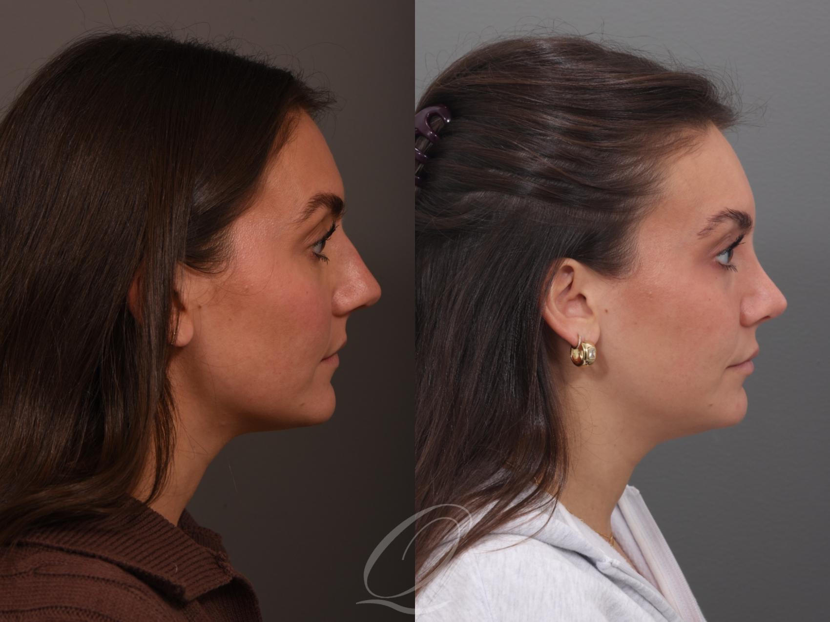 Rhinoplasty Case 1001970 Before & After Right Side | Serving Rochester, Syracuse & Buffalo, NY | Quatela Center for Plastic Surgery