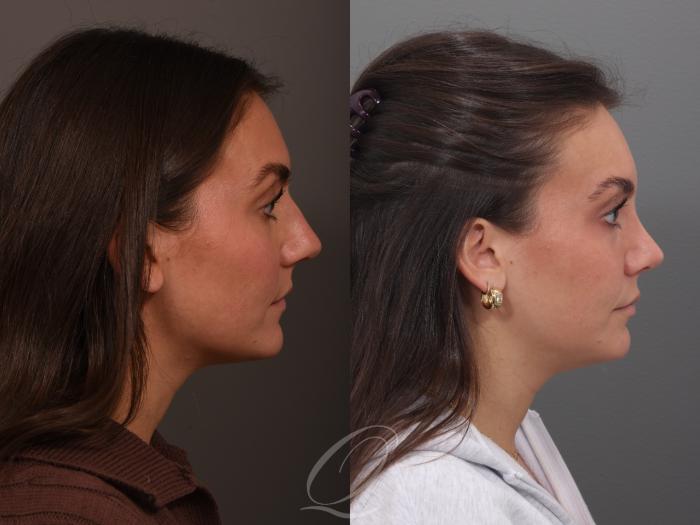 Rhinoplasty Case 1001970 Before & After Right Side | Serving Rochester, Syracuse & Buffalo, NY | Quatela Center for Plastic Surgery