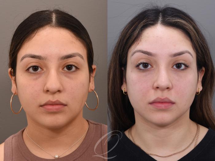 Rhinoplasty Case 1001971 Before & After Front | Serving Rochester, Syracuse & Buffalo, NY | Quatela Center for Plastic Surgery