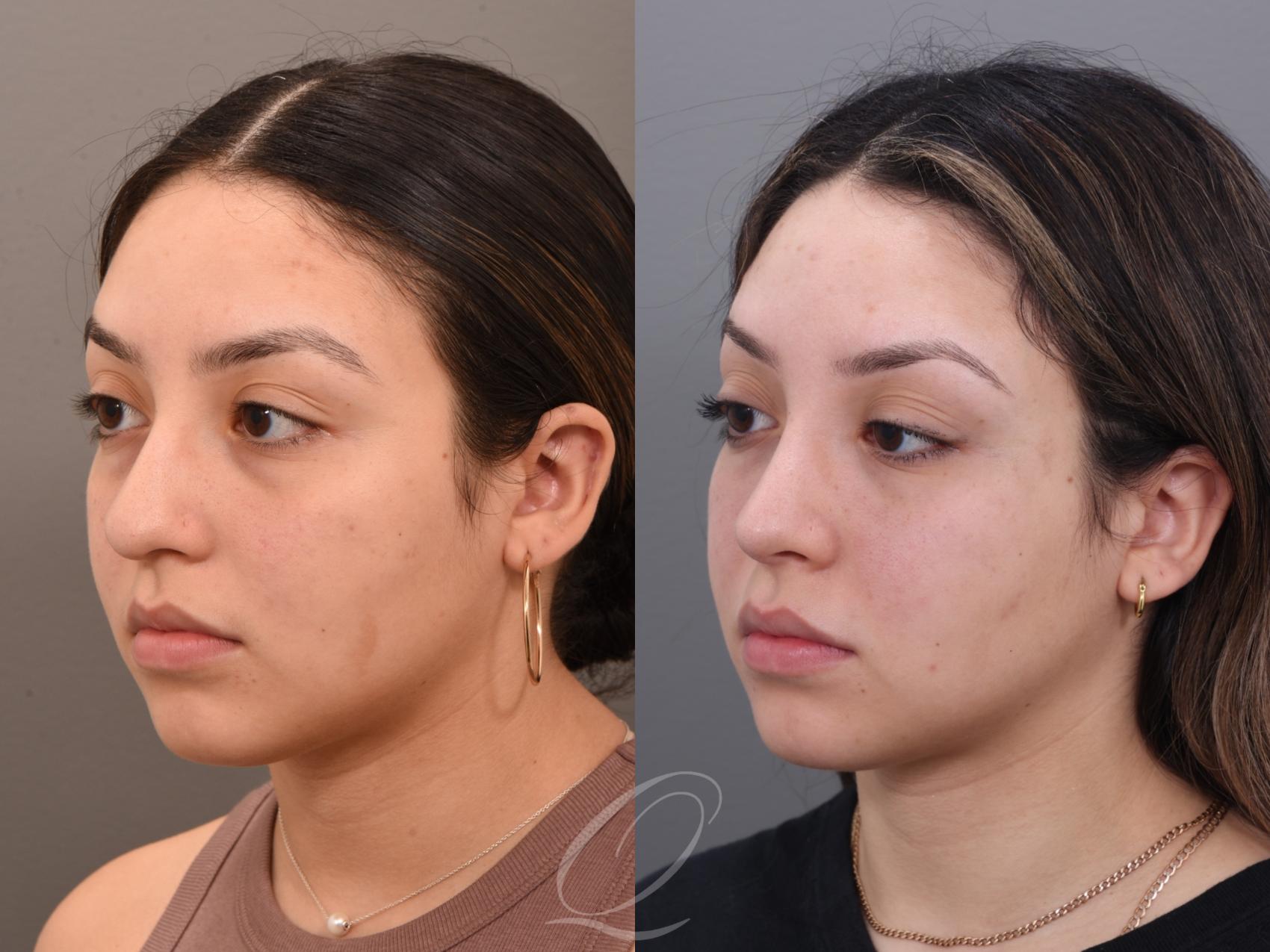 Rhinoplasty Case 1001971 Before & After Left Oblique | Serving Rochester, Syracuse & Buffalo, NY | Quatela Center for Plastic Surgery