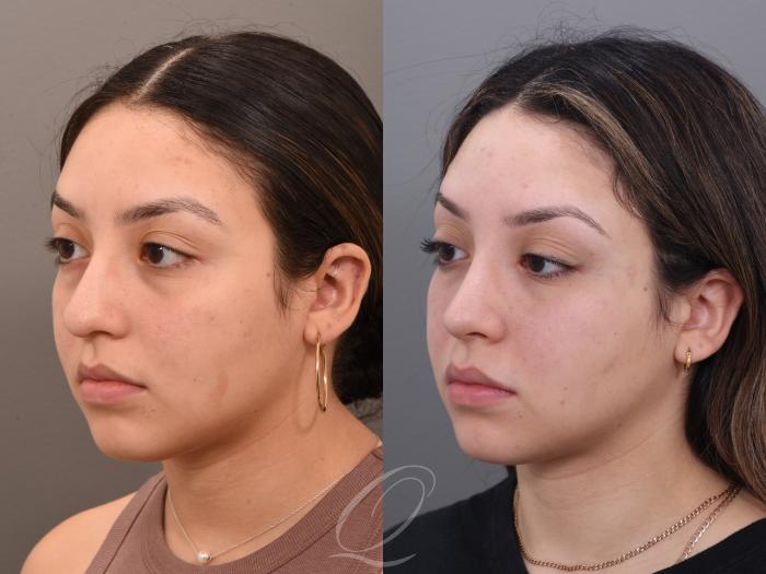 Rhinoplasty Case 1001971 Before & After Left Oblique | Serving Rochester, Syracuse & Buffalo, NY | Quatela Center for Plastic Surgery
