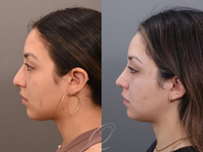 Rhinoplasty Case 1001971 Before & After Left Side | Serving Rochester, Syracuse & Buffalo, NY | Quatela Center for Plastic Surgery