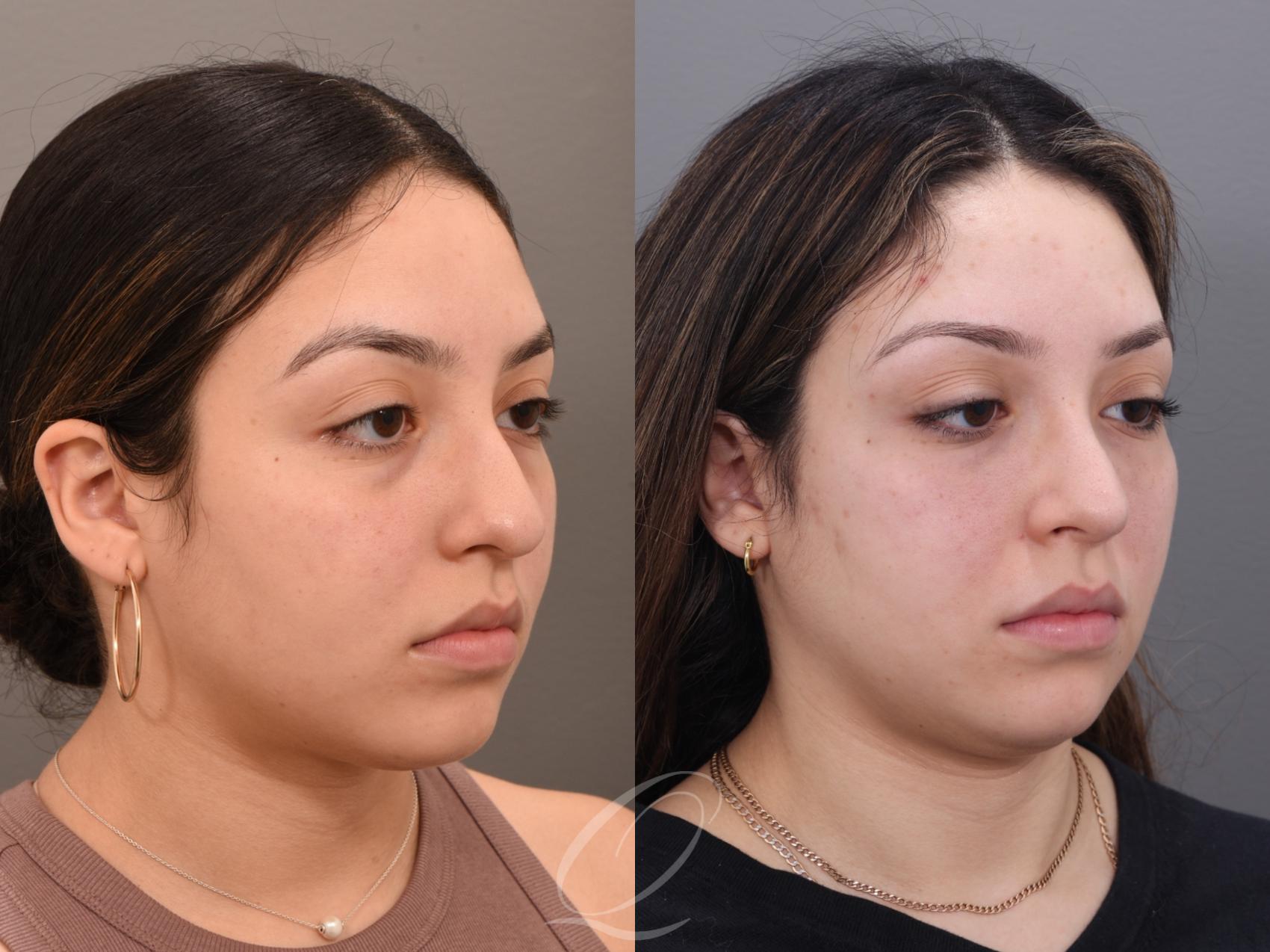 Rhinoplasty Case 1001971 Before & After Right Oblique | Serving Rochester, Syracuse & Buffalo, NY | Quatela Center for Plastic Surgery