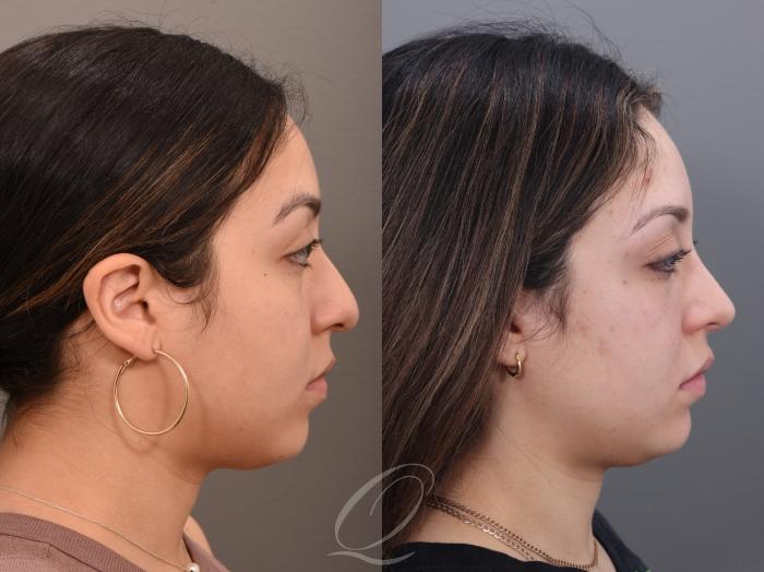 Rhinoplasty Case 1001971 Before & After Right Side | Serving Rochester, Syracuse & Buffalo, NY | Quatela Center for Plastic Surgery