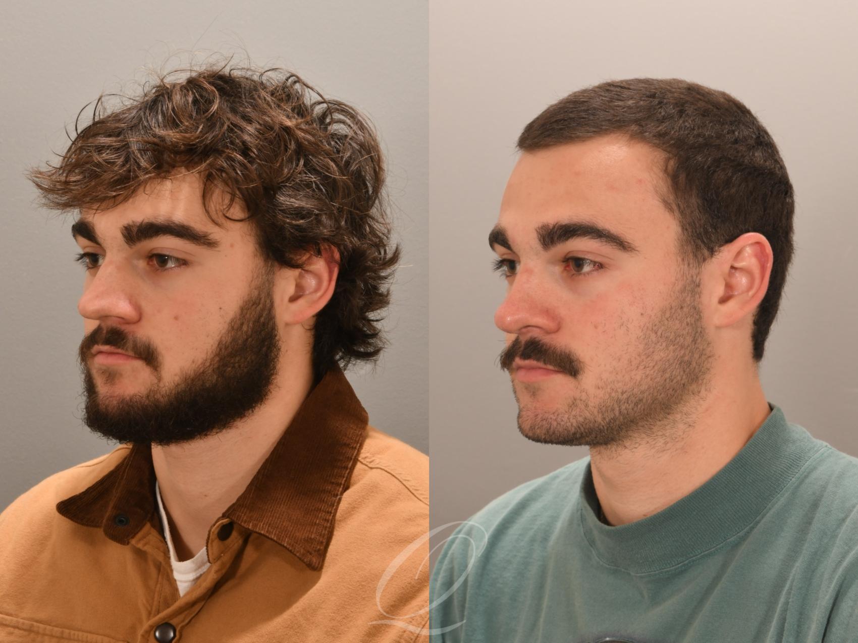 Rhinoplasty Case 1001981 Before & After Left Oblique | Serving Rochester, Syracuse & Buffalo, NY | Quatela Center for Plastic Surgery