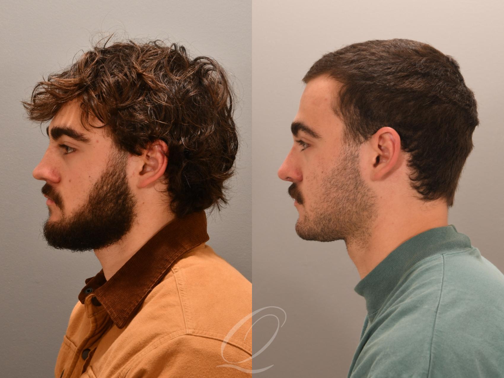 Rhinoplasty Case 1001981 Before & After Left Side | Serving Rochester, Syracuse & Buffalo, NY | Quatela Center for Plastic Surgery
