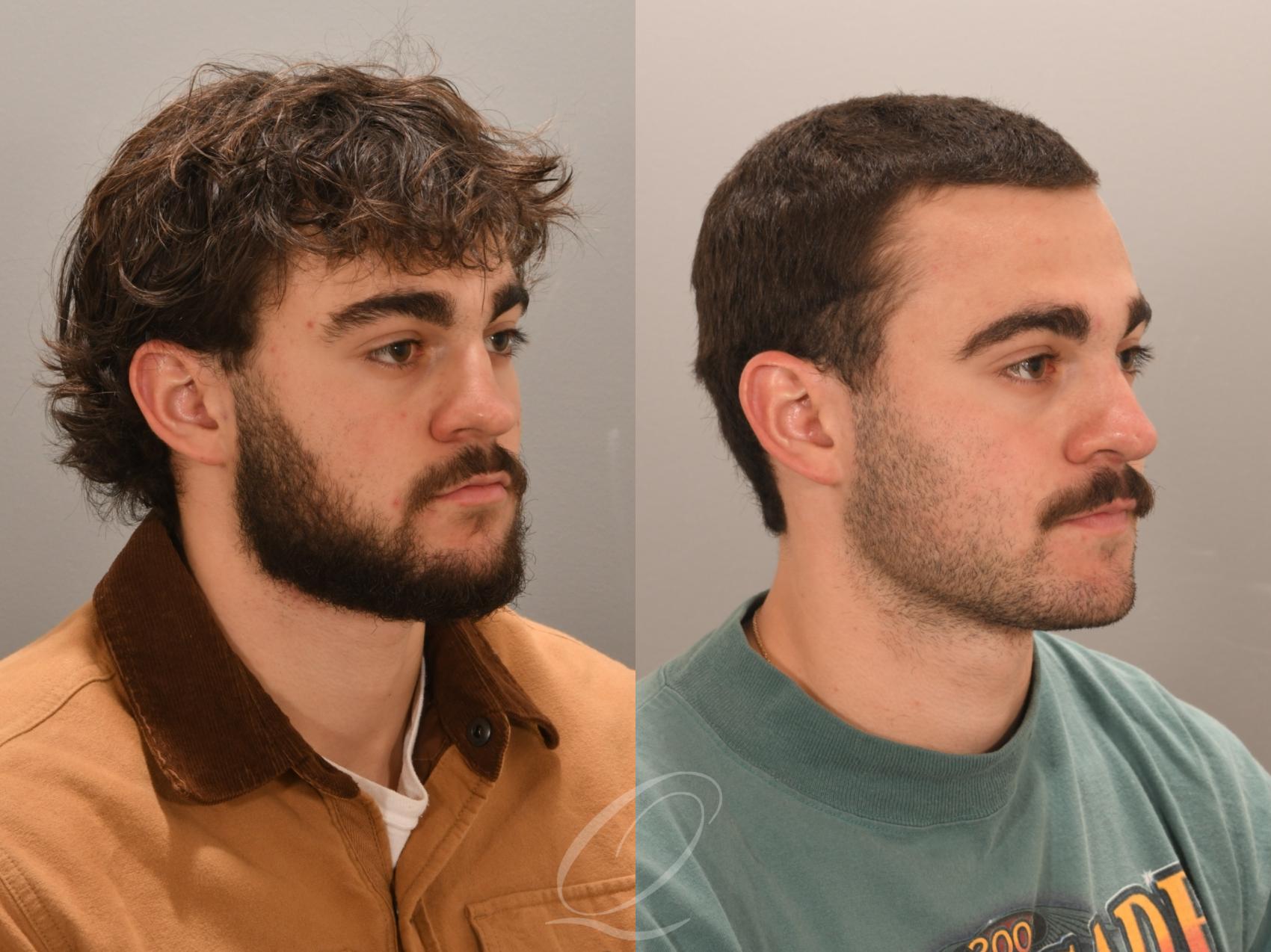 Rhinoplasty Case 1001981 Before & After Right Oblique | Serving Rochester, Syracuse & Buffalo, NY | Quatela Center for Plastic Surgery