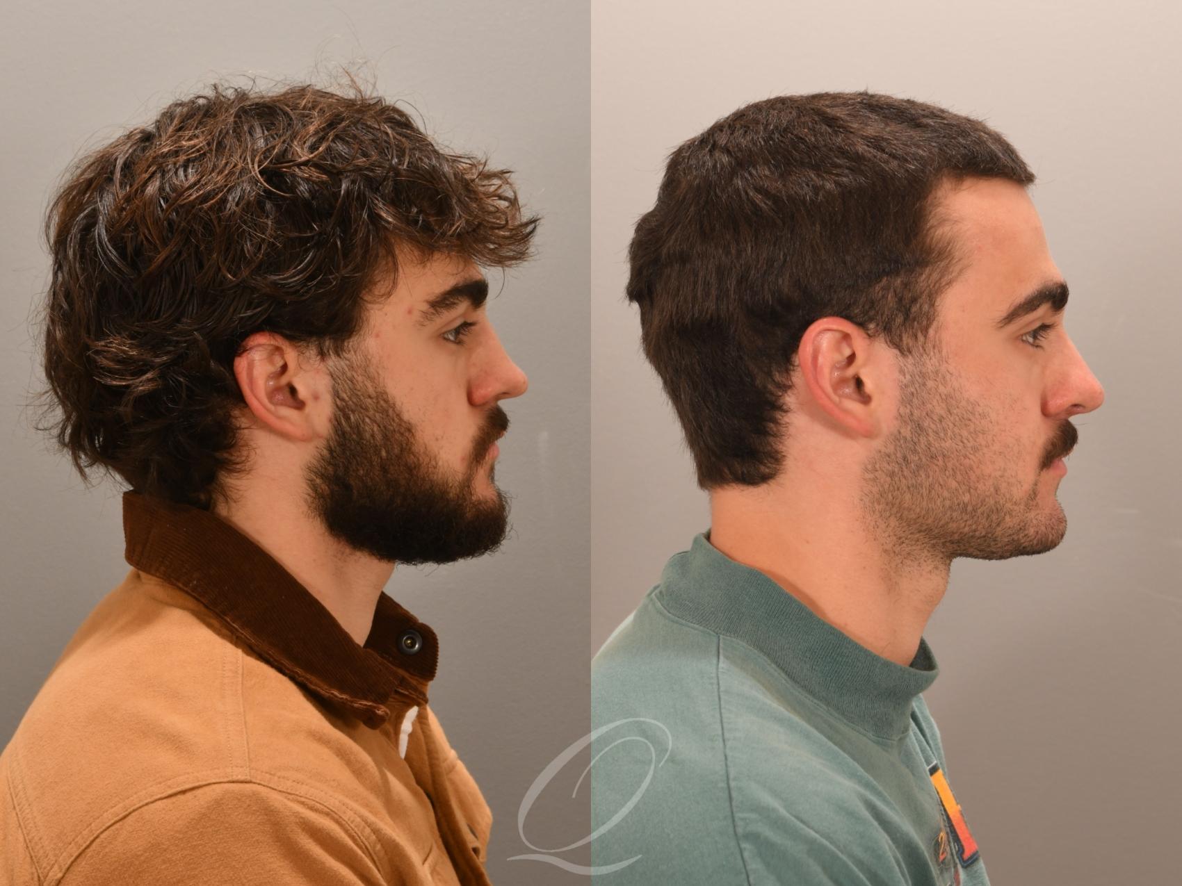 Rhinoplasty Case 1001981 Before & After Right Side | Serving Rochester, Syracuse & Buffalo, NY | Quatela Center for Plastic Surgery