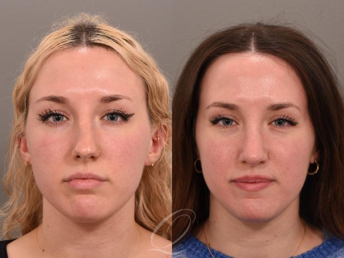 Rhinoplasty Case 1001982 Before & After Front | Serving Rochester, Syracuse & Buffalo, NY | Quatela Center for Plastic Surgery