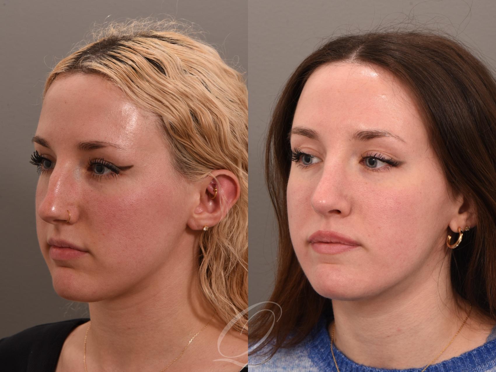 Rhinoplasty Case 1001982 Before & After Left Oblique | Serving Rochester, Syracuse & Buffalo, NY | Quatela Center for Plastic Surgery