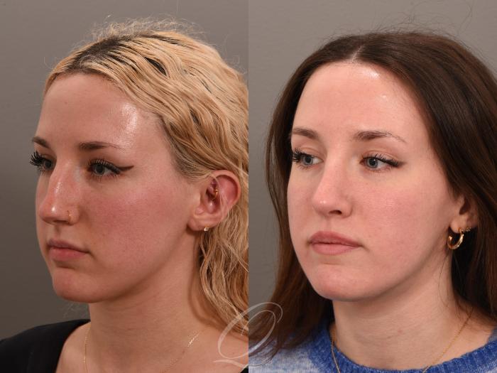Rhinoplasty Case 1001982 Before & After Left Oblique | Serving Rochester, Syracuse & Buffalo, NY | Quatela Center for Plastic Surgery