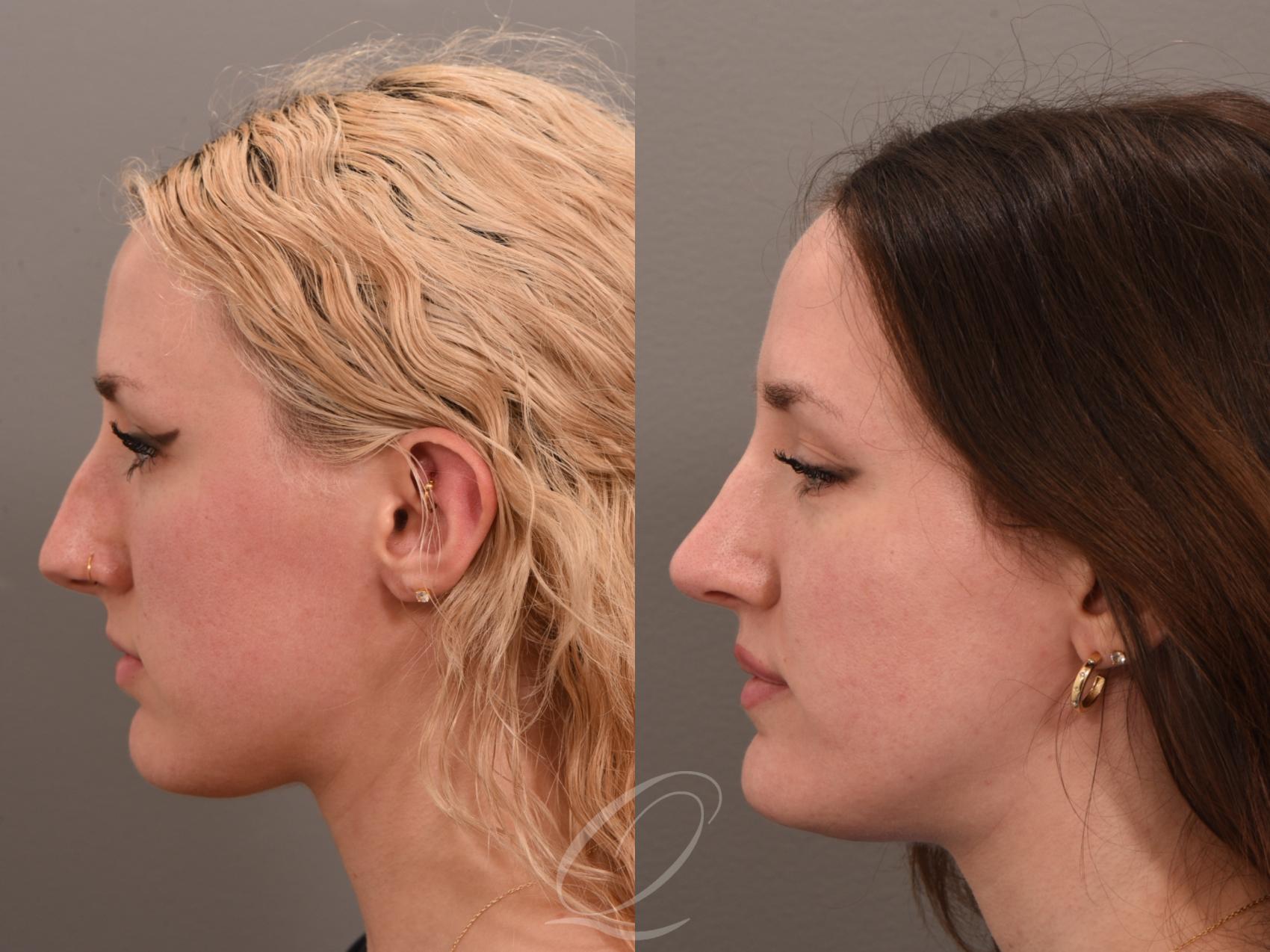 Rhinoplasty Case 1001982 Before & After Left Side | Serving Rochester, Syracuse & Buffalo, NY | Quatela Center for Plastic Surgery