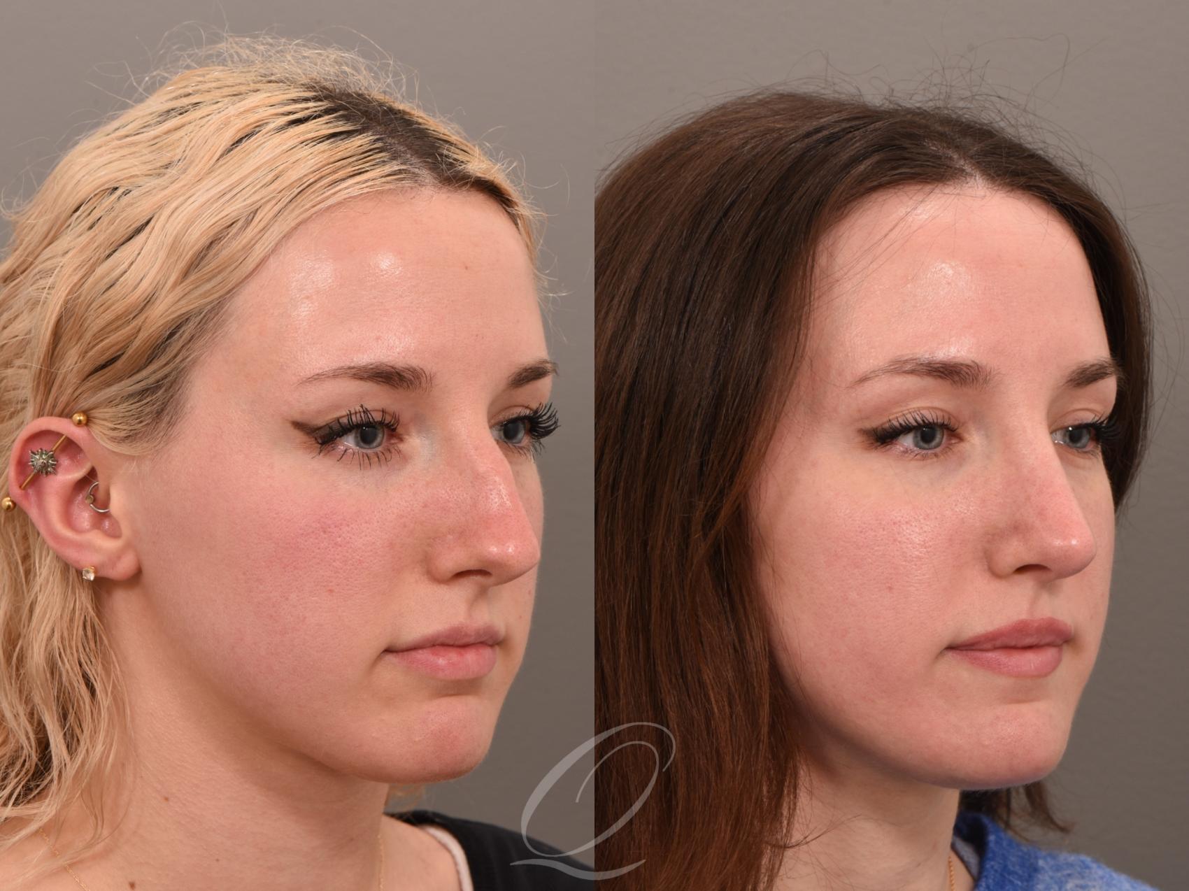 Rhinoplasty Case 1001982 Before & After Right Oblique | Serving Rochester, Syracuse & Buffalo, NY | Quatela Center for Plastic Surgery