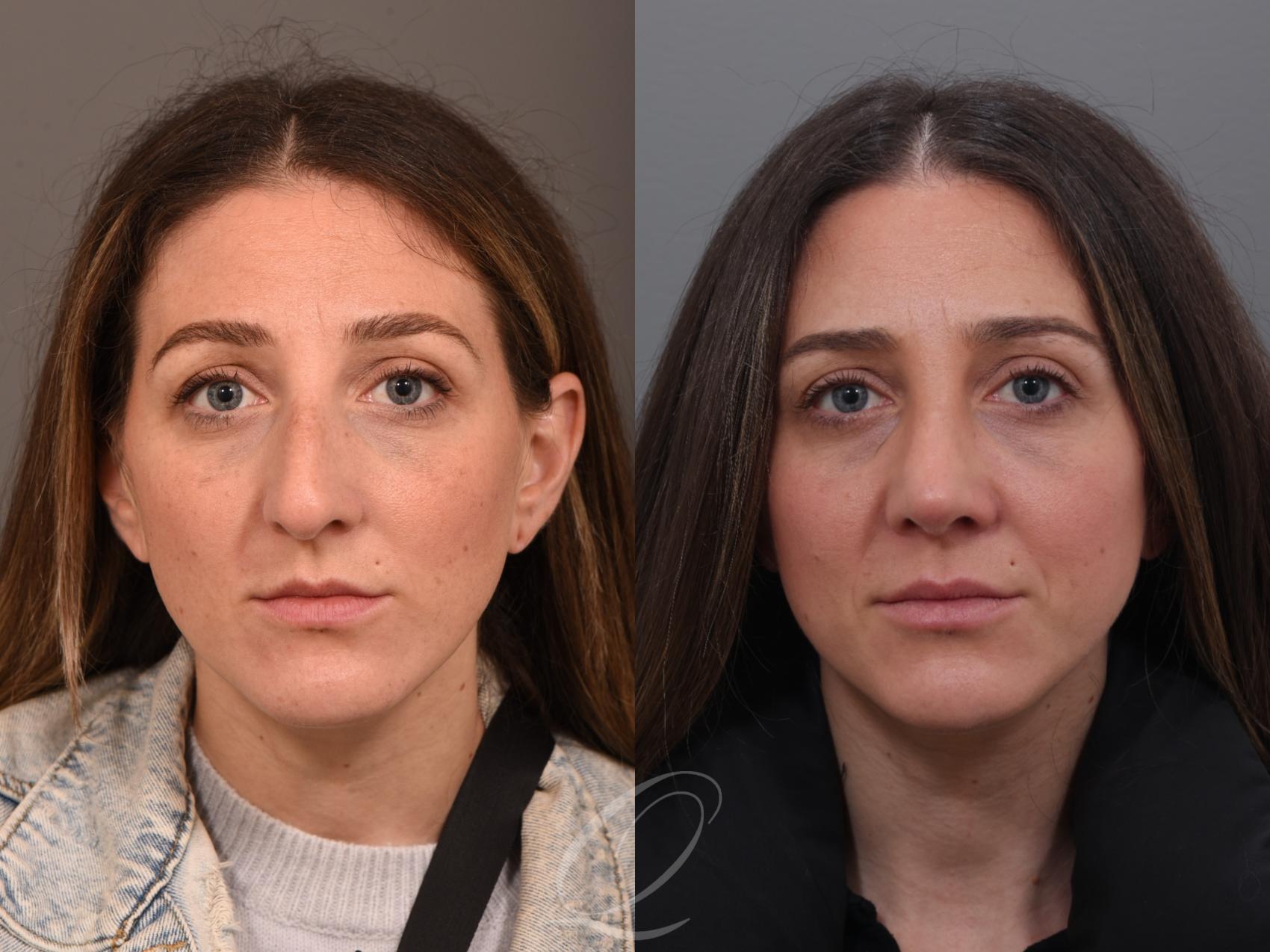 Rhinoplasty Case 1001985 Before & After Front | Serving Rochester, Syracuse & Buffalo, NY | Quatela Center for Plastic Surgery