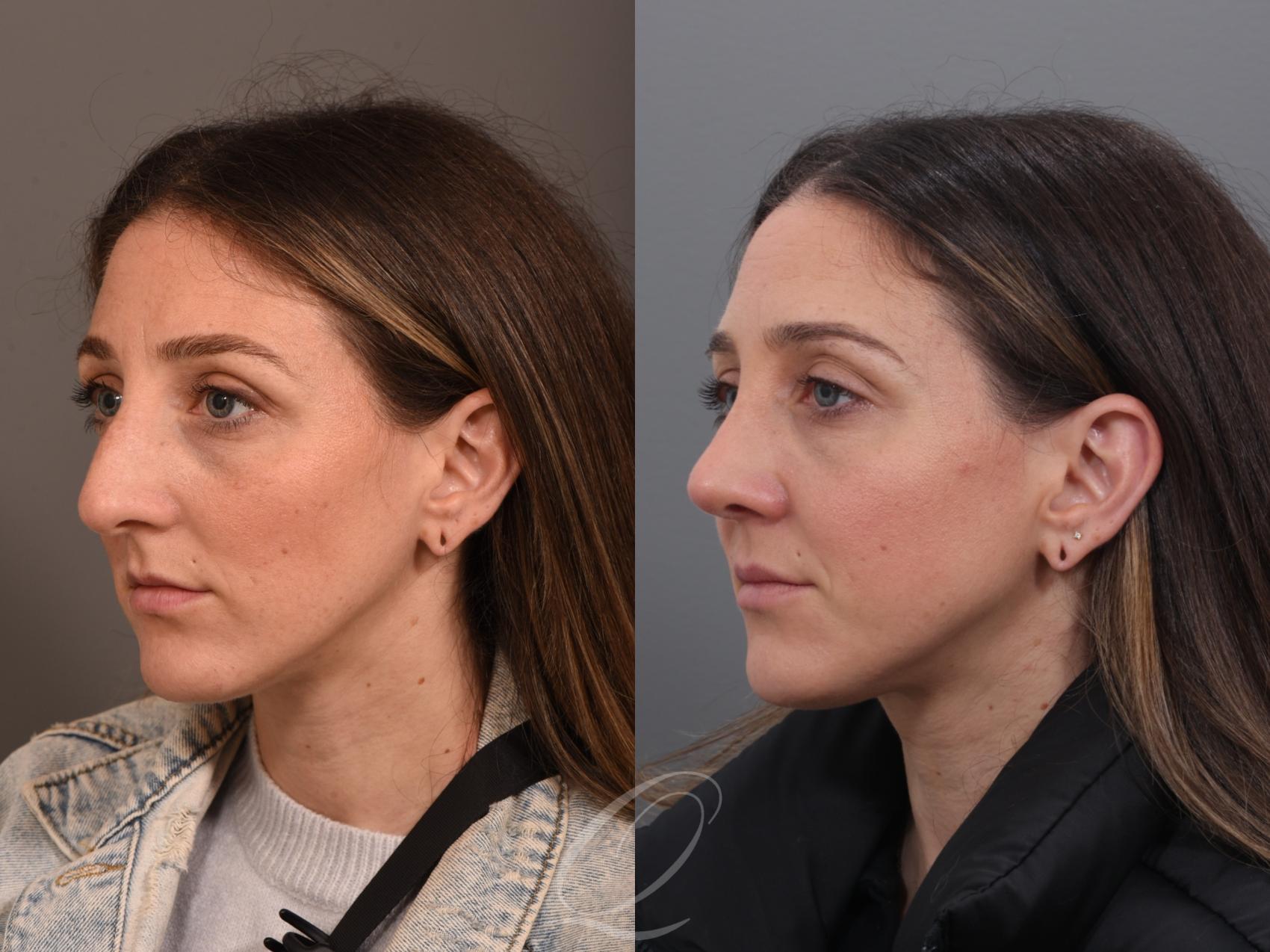 Rhinoplasty Case 1001985 Before & After Left Oblique | Serving Rochester, Syracuse & Buffalo, NY | Quatela Center for Plastic Surgery