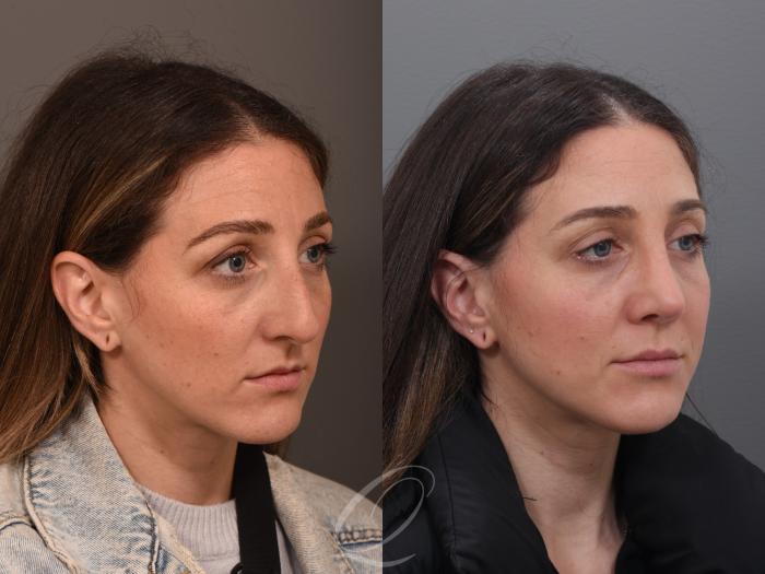 Rhinoplasty Case 1001985 Before & After Right Oblique | Serving Rochester, Syracuse & Buffalo, NY | Quatela Center for Plastic Surgery