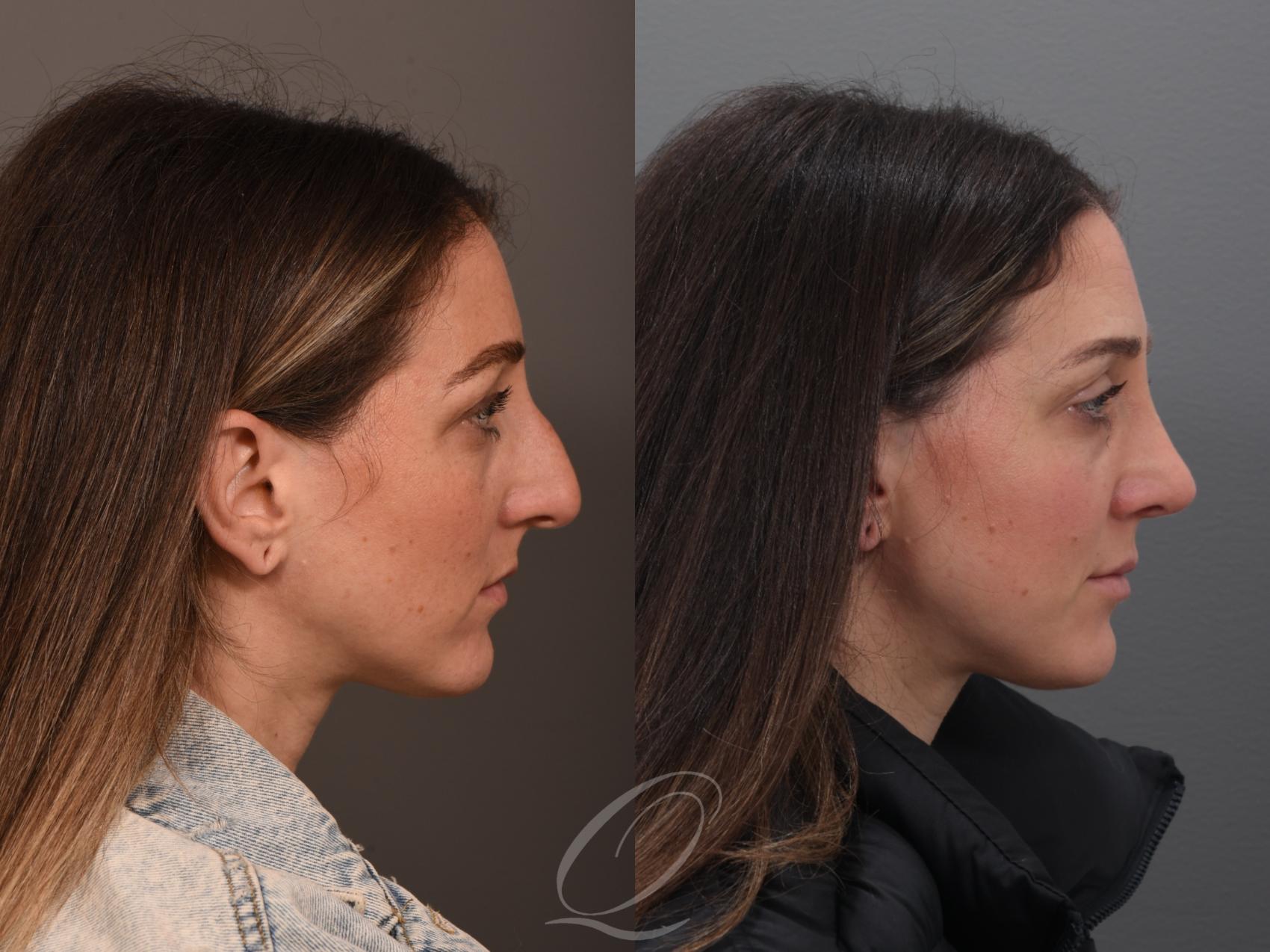 Rhinoplasty Case 1001985 Before & After Right Side | Serving Rochester, Syracuse & Buffalo, NY | Quatela Center for Plastic Surgery