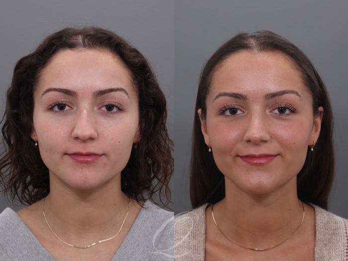 Rhinoplasty Case 1002005 Before & After Front | Serving Rochester, Syracuse & Buffalo, NY | Quatela Center for Plastic Surgery