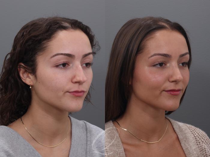 Rhinoplasty Case 1002005 Before & After Left Oblique | Serving Rochester, Syracuse & Buffalo, NY | Quatela Center for Plastic Surgery