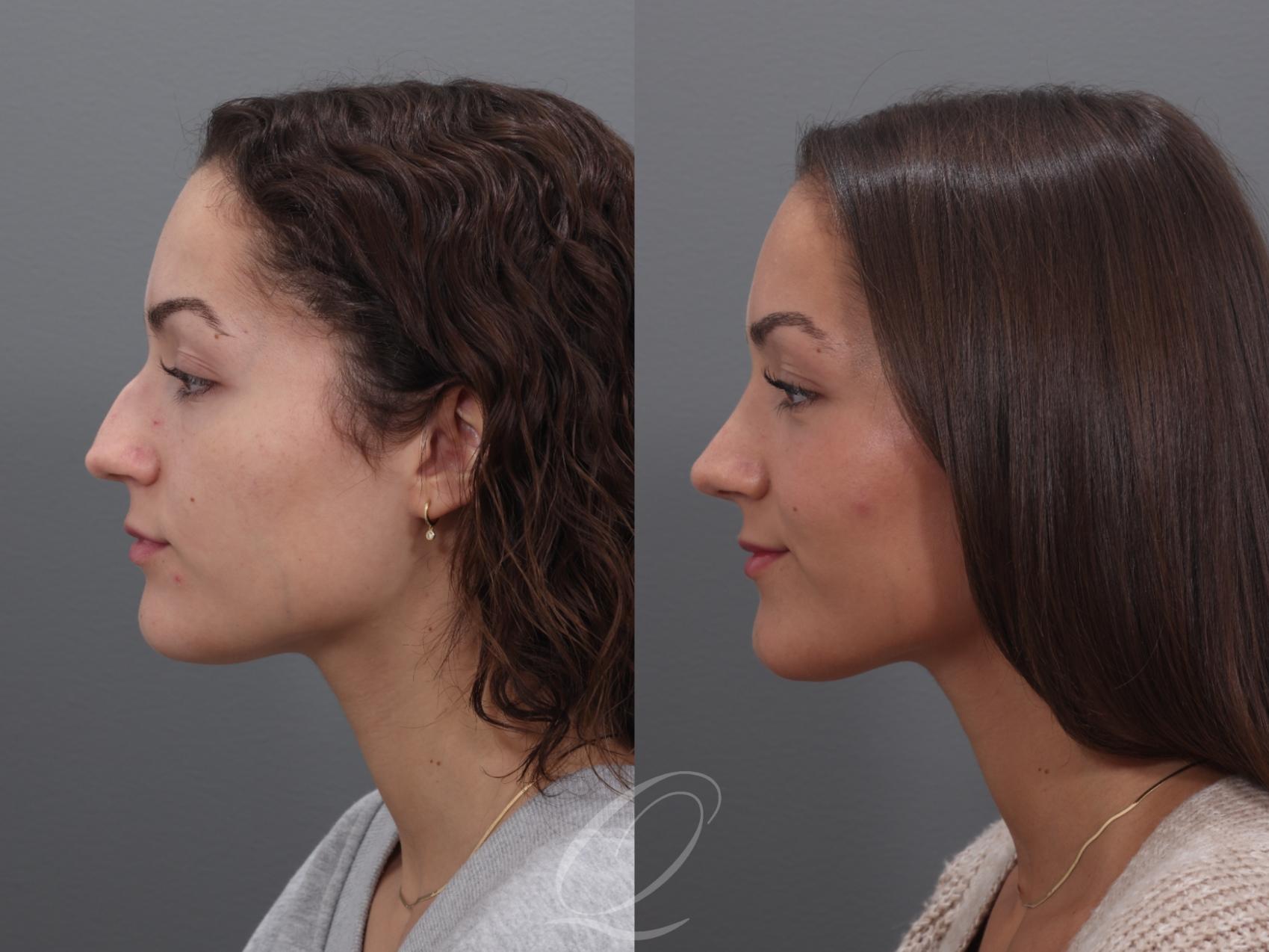 Rhinoplasty Case 1002005 Before & After Left Side | Serving Rochester, Syracuse & Buffalo, NY | Quatela Center for Plastic Surgery