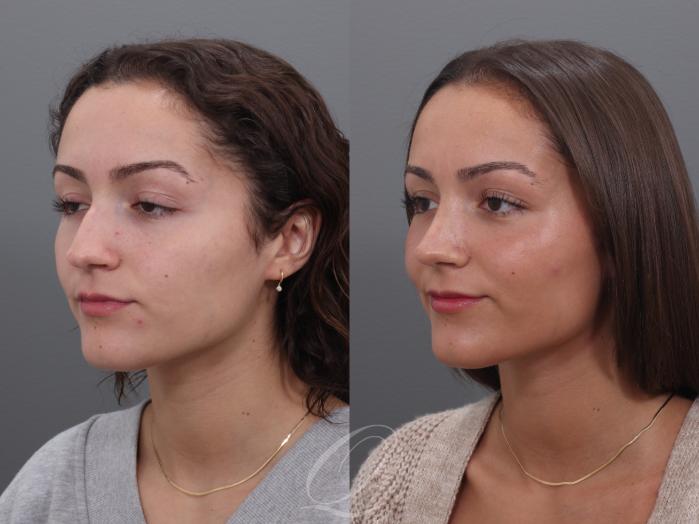 Rhinoplasty Case 1002005 Before & After Right Oblique | Serving Rochester, Syracuse & Buffalo, NY | Quatela Center for Plastic Surgery