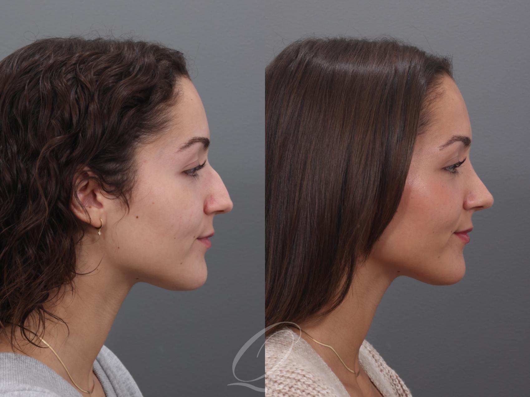 Rhinoplasty Case 1002005 Before & After Right Side | Serving Rochester, Syracuse & Buffalo, NY | Quatela Center for Plastic Surgery