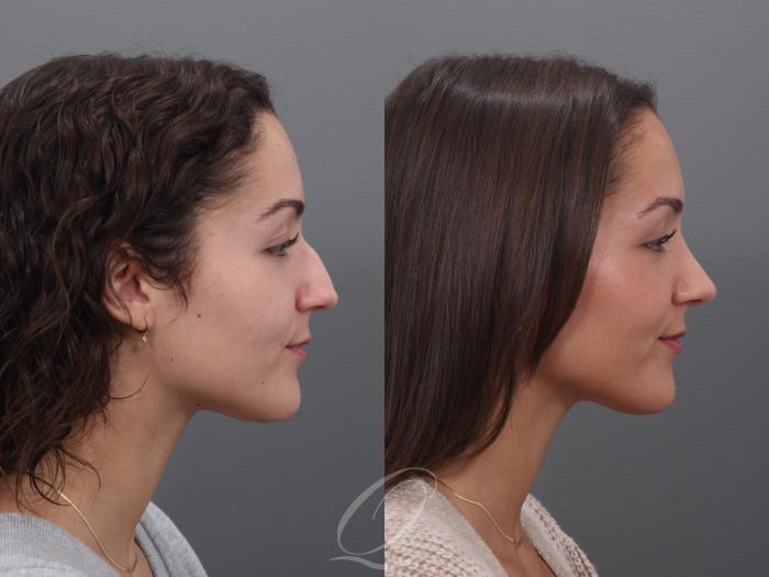 Rhinoplasty Case 1002005 Before & After Right Side | Serving Rochester, Syracuse & Buffalo, NY | Quatela Center for Plastic Surgery