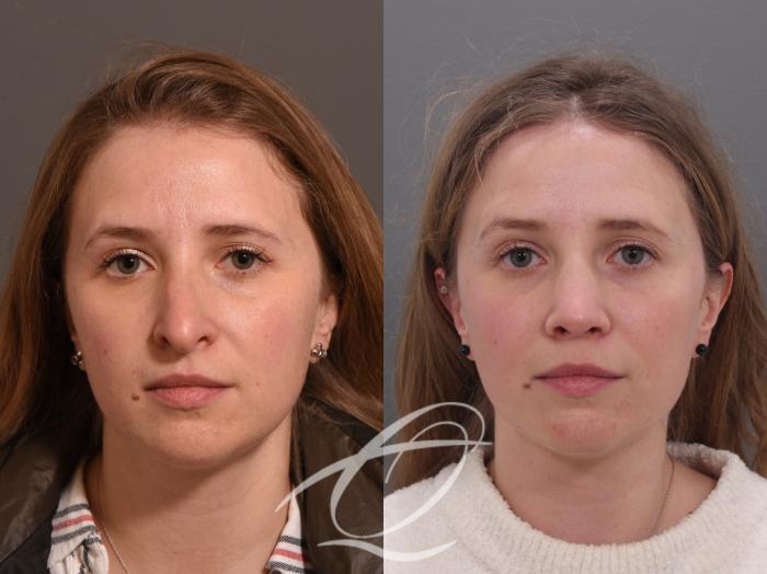 Rhinoplasty Case 1002009 Before & After Front | Serving Rochester, Syracuse & Buffalo, NY | Quatela Center for Plastic Surgery