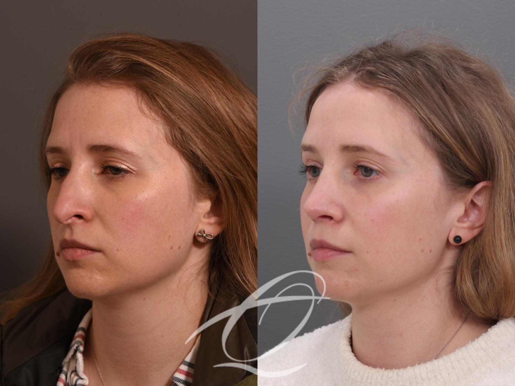 Rhinoplasty Case 1002009 Before & After Left Oblique | Serving Rochester, Syracuse & Buffalo, NY | Quatela Center for Plastic Surgery