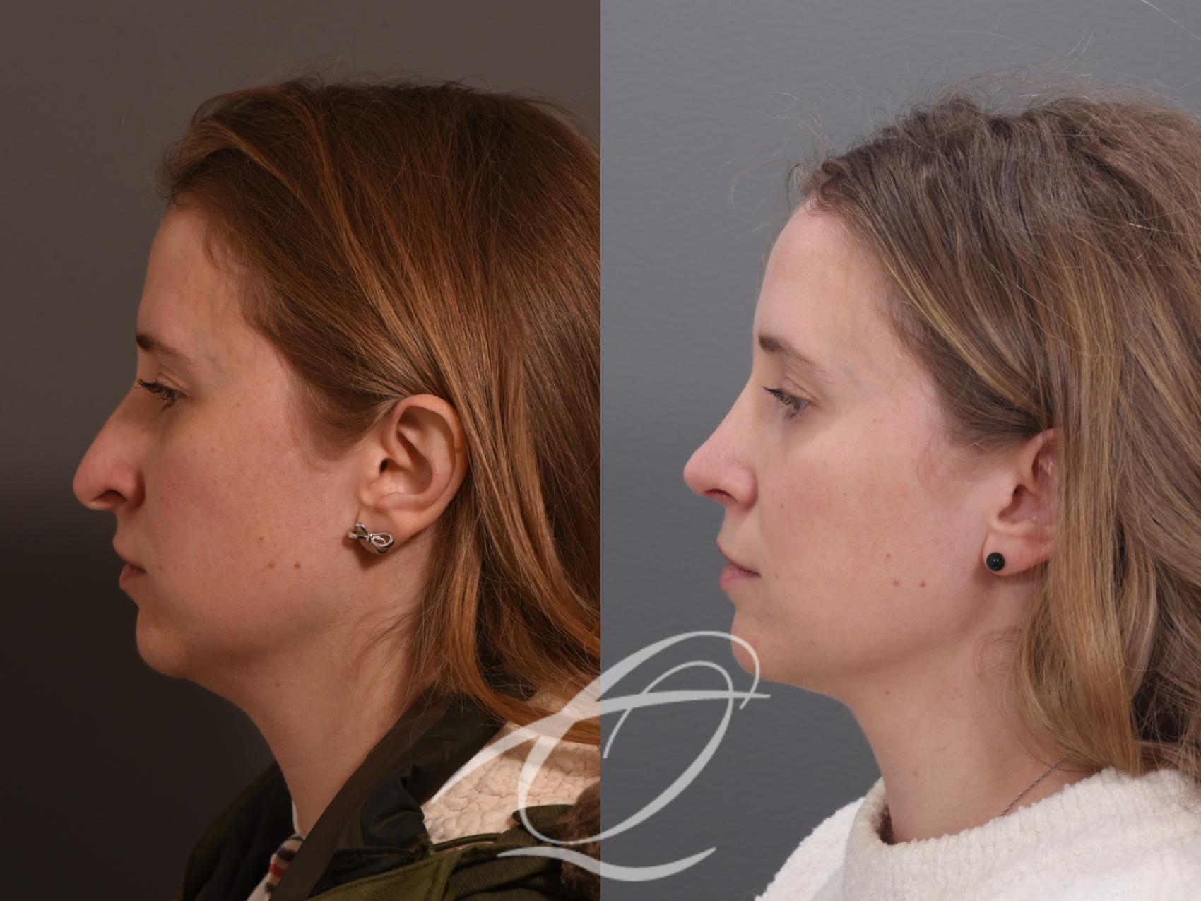 Rhinoplasty Case 1002009 Before & After Left Side | Serving Rochester, Syracuse & Buffalo, NY | Quatela Center for Plastic Surgery