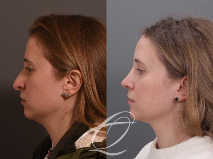 Rhinoplasty Case 1002009 Before & After Left Side | Serving Rochester, Syracuse & Buffalo, NY | Quatela Center for Plastic Surgery