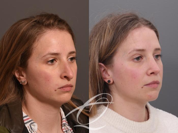 Rhinoplasty Case 1002009 Before & After Right Oblique | Serving Rochester, Syracuse & Buffalo, NY | Quatela Center for Plastic Surgery