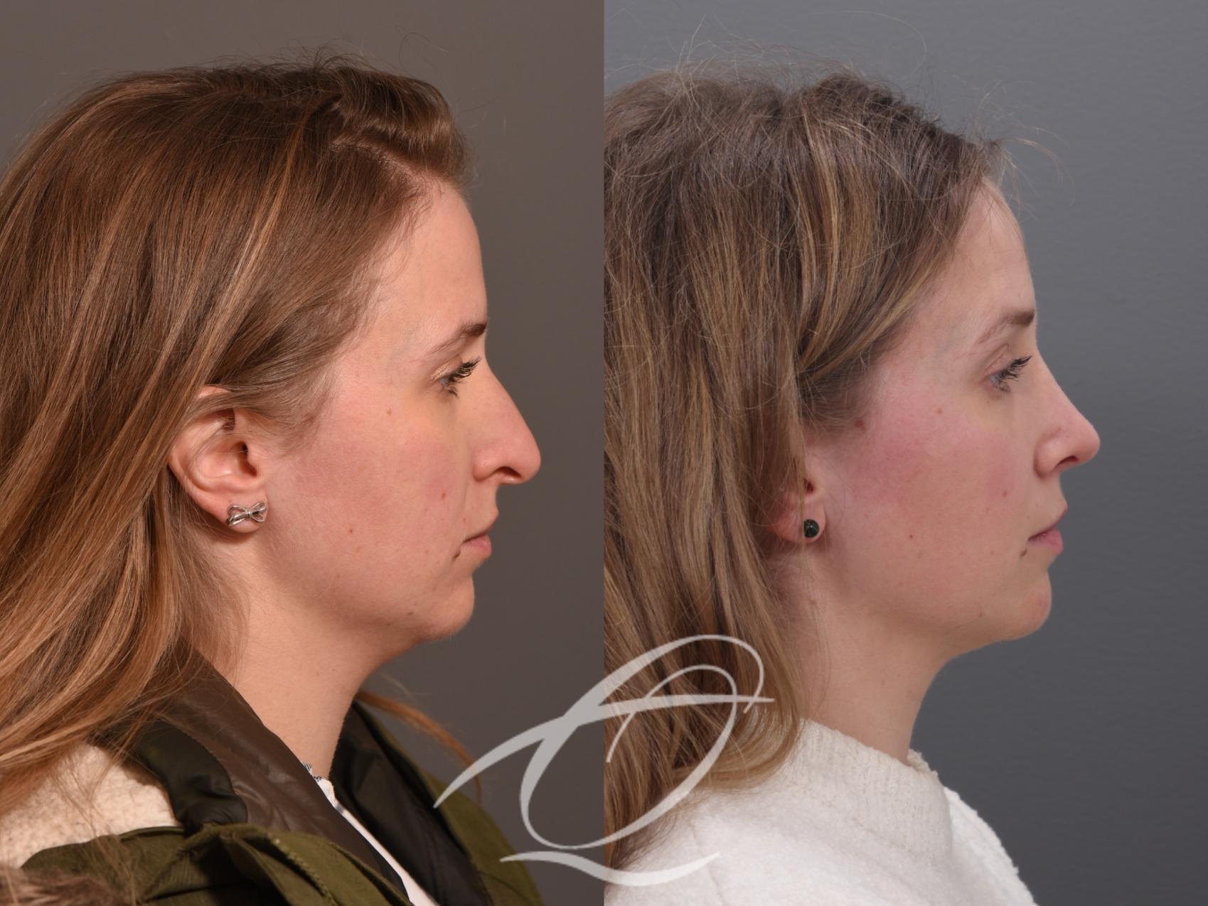 Rhinoplasty Case 1002009 Before & After Right Side | Serving Rochester, Syracuse & Buffalo, NY | Quatela Center for Plastic Surgery