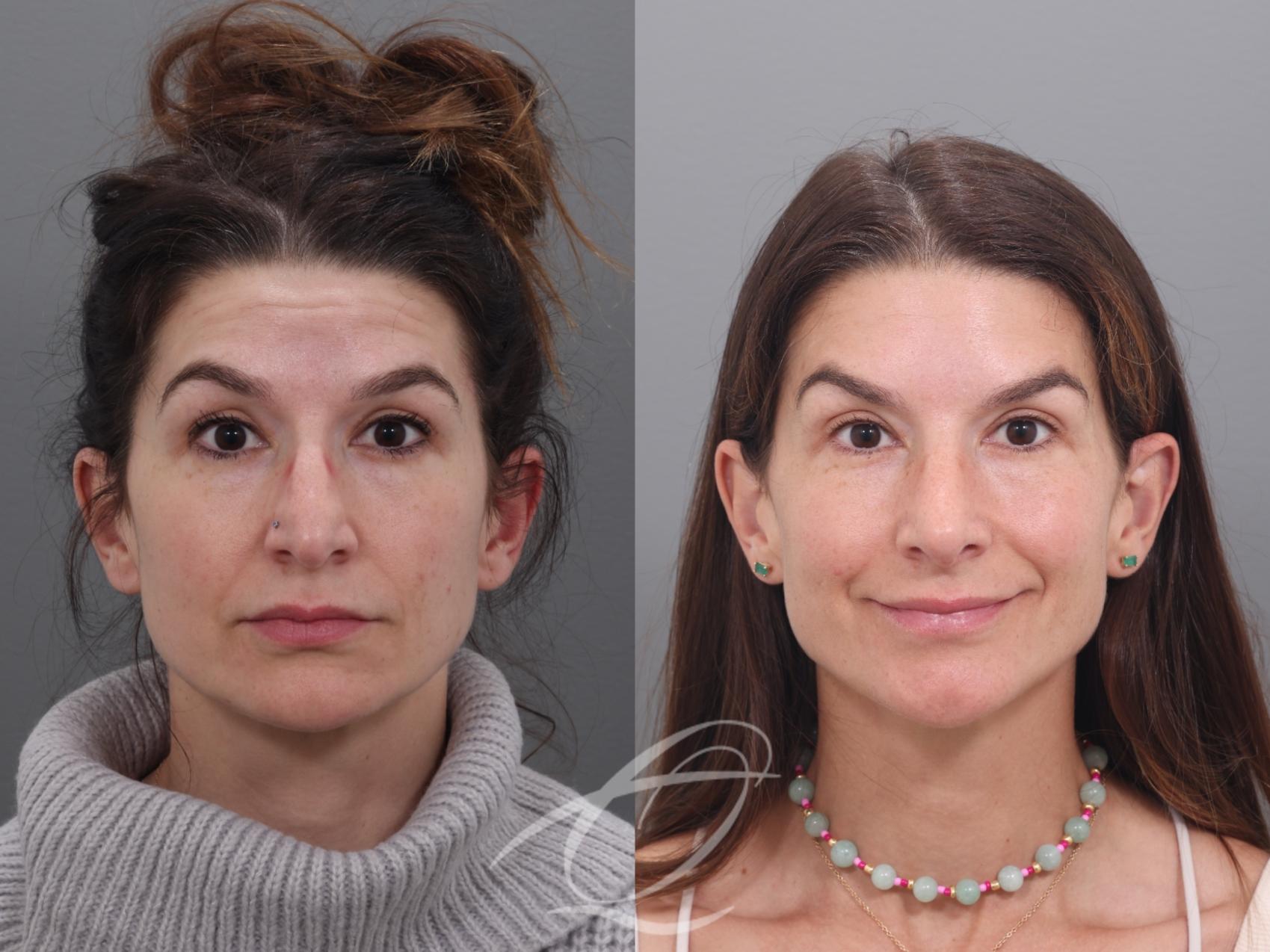 Rhinoplasty Case 1002017 Before & After Front | Serving Rochester, Syracuse & Buffalo, NY | Quatela Center for Plastic Surgery