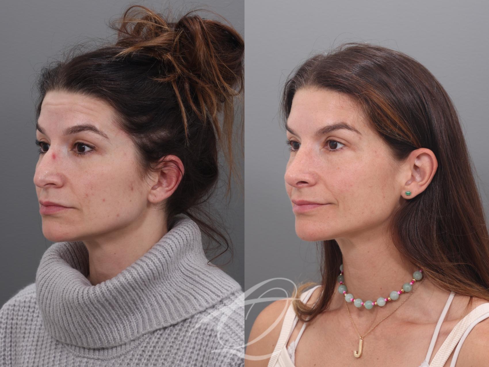 Rhinoplasty Case 1002017 Before & After Left Oblique | Serving Rochester, Syracuse & Buffalo, NY | Quatela Center for Plastic Surgery