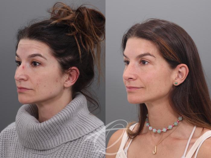 Rhinoplasty Case 1002017 Before & After Left Oblique | Serving Rochester, Syracuse & Buffalo, NY | Quatela Center for Plastic Surgery