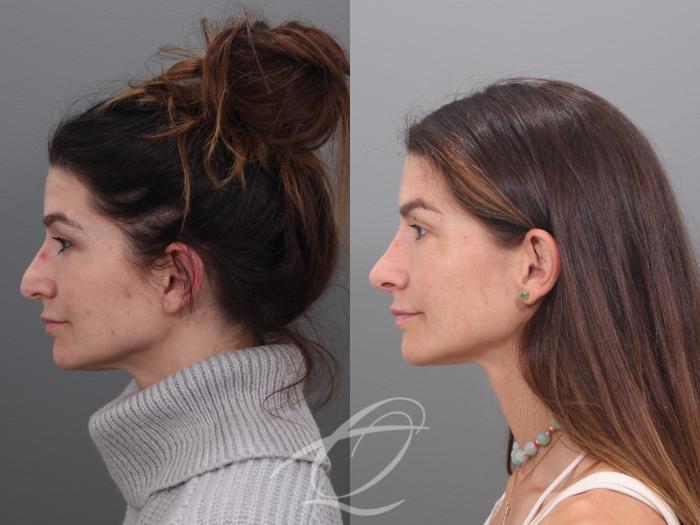 Rhinoplasty Case 1002017 Before & After Left Side | Serving Rochester, Syracuse & Buffalo, NY | Quatela Center for Plastic Surgery