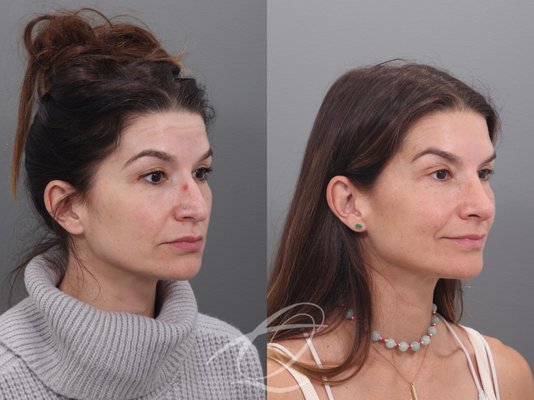 Rhinoplasty Case 1002017 Before & After Right Oblique | Serving Rochester, Syracuse & Buffalo, NY | Quatela Center for Plastic Surgery