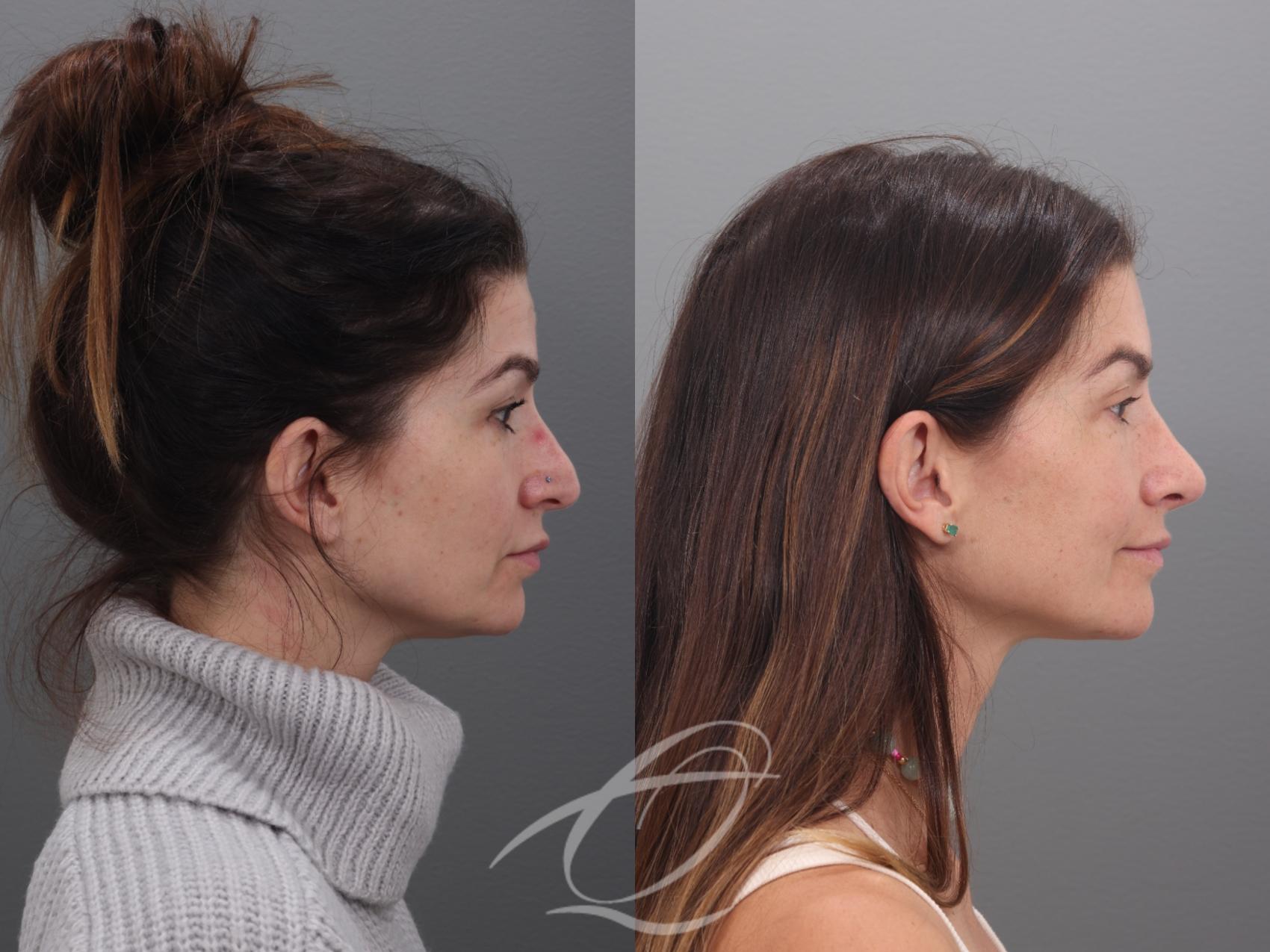 Rhinoplasty Case 1002017 Before & After Right Side | Serving Rochester, Syracuse & Buffalo, NY | Quatela Center for Plastic Surgery