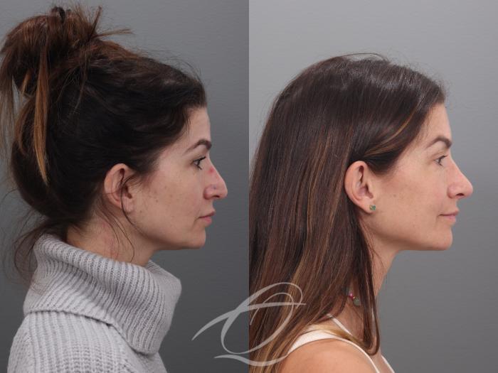 Rhinoplasty Case 1002017 Before & After Right Side | Serving Rochester, Syracuse & Buffalo, NY | Quatela Center for Plastic Surgery
