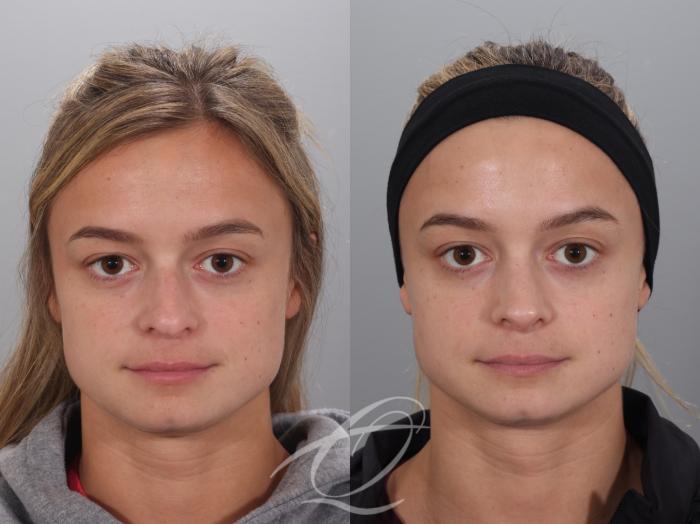 Rhinoplasty Case 1002023 Before & After Front | Serving Rochester, Syracuse & Buffalo, NY | Quatela Center for Plastic Surgery
