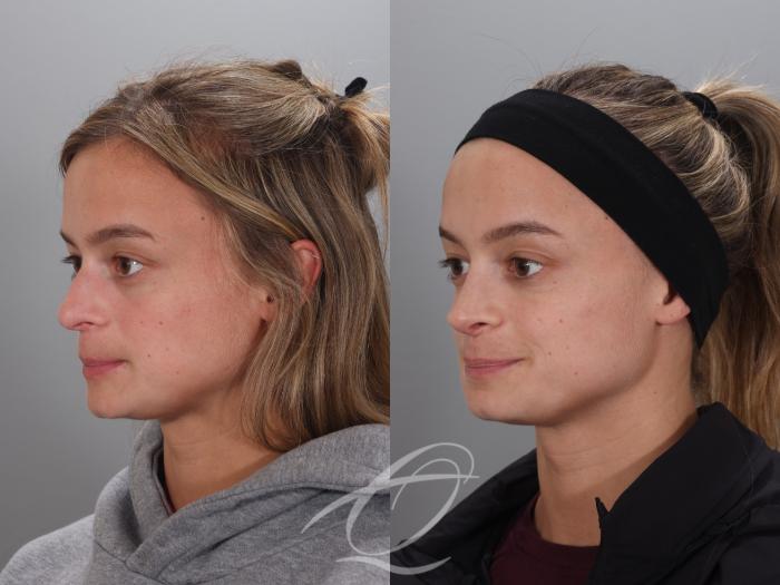 Rhinoplasty Case 1002023 Before & After Left Oblique | Serving Rochester, Syracuse & Buffalo, NY | Quatela Center for Plastic Surgery
