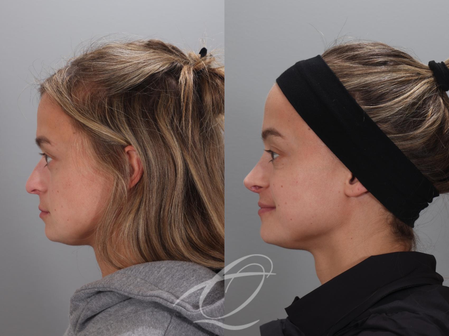 Rhinoplasty Case 1002023 Before & After Left Side | Serving Rochester, Syracuse & Buffalo, NY | Quatela Center for Plastic Surgery