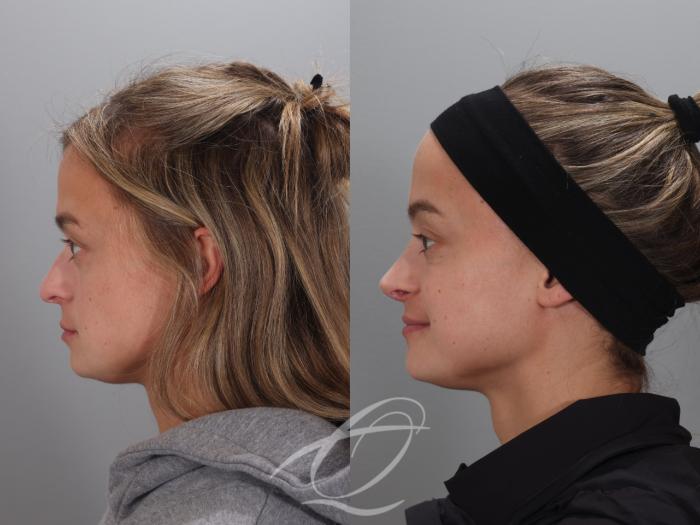Rhinoplasty Case 1002023 Before & After Left Side | Serving Rochester, Syracuse & Buffalo, NY | Quatela Center for Plastic Surgery