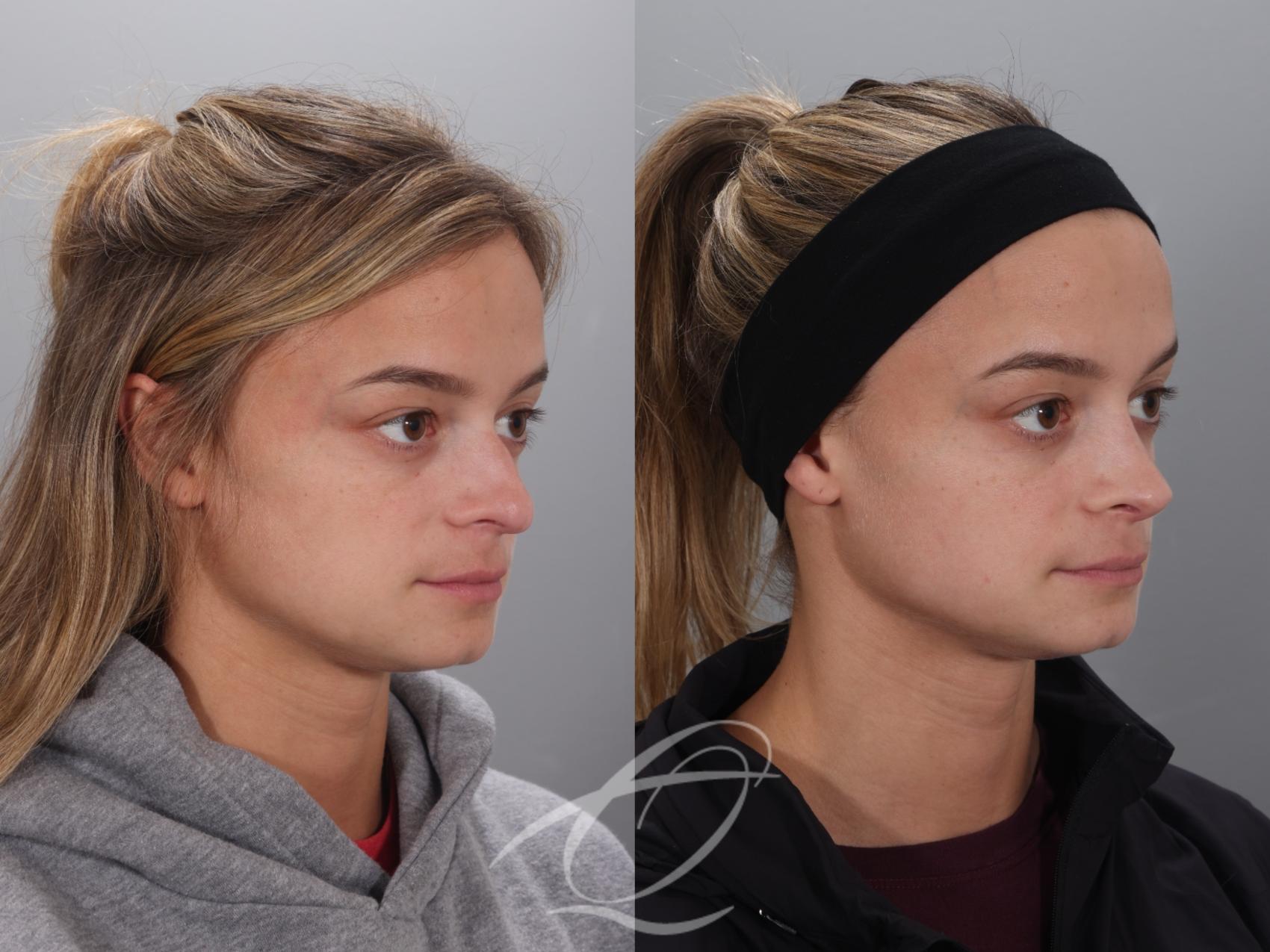 Rhinoplasty Case 1002023 Before & After Right Oblique | Serving Rochester, Syracuse & Buffalo, NY | Quatela Center for Plastic Surgery