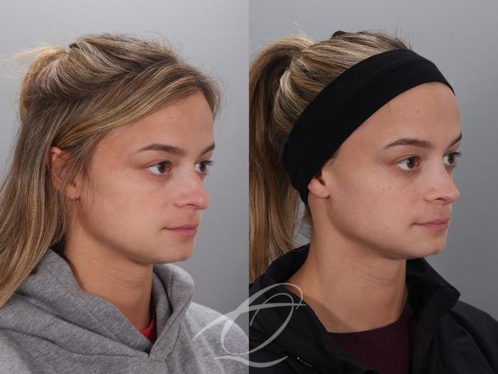 Rhinoplasty Case 1002023 Before & After Right Oblique | Serving Rochester, Syracuse & Buffalo, NY | Quatela Center for Plastic Surgery